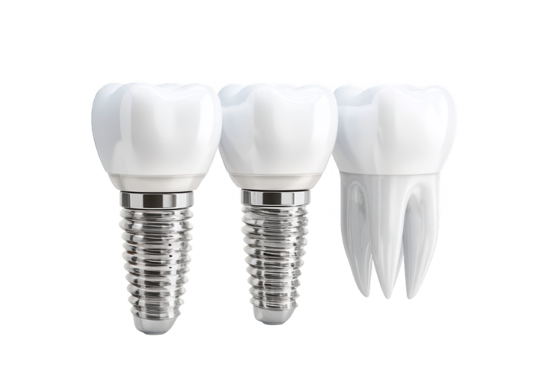 Implant dentaire en gros plan dans une bouche.